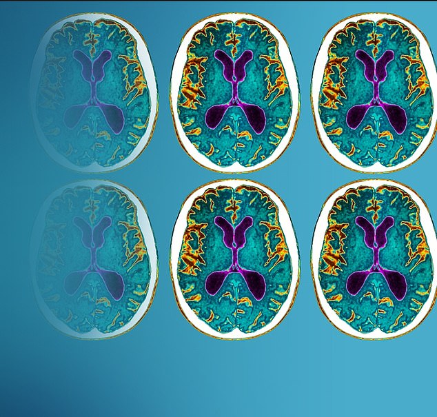 The drug first attracted public attention in September when Eisai published the results of a major trial involving 1,800 participants and carried out over 18 months at 240 sites across the world, including the US, UK and Australia. It was found to slow cognitive decline by a third and was the first treatment proven to delay progression of the disease